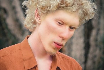 Albinismo, cause, genetica, trattamento