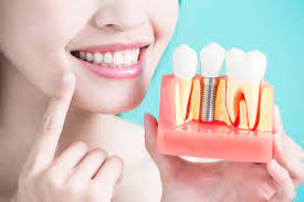 Understanding Dental Implant Costs in Mukherjee Nagar: What You Need to Know