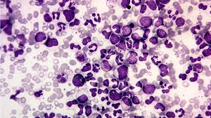 Chronic Myeloid Leukemia (CML) Treatment Market Size Key Trends Challenges, Top Key Players and Forecast to 2024 – 2032