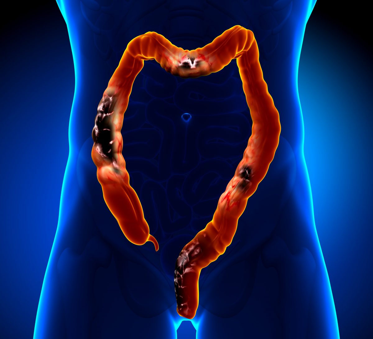 Colorectal Cancer Screening and Diagnostic Market Analysis, Business Development, Size, Share, Trends, Industry Analysis, Forecast 2024 – 2032