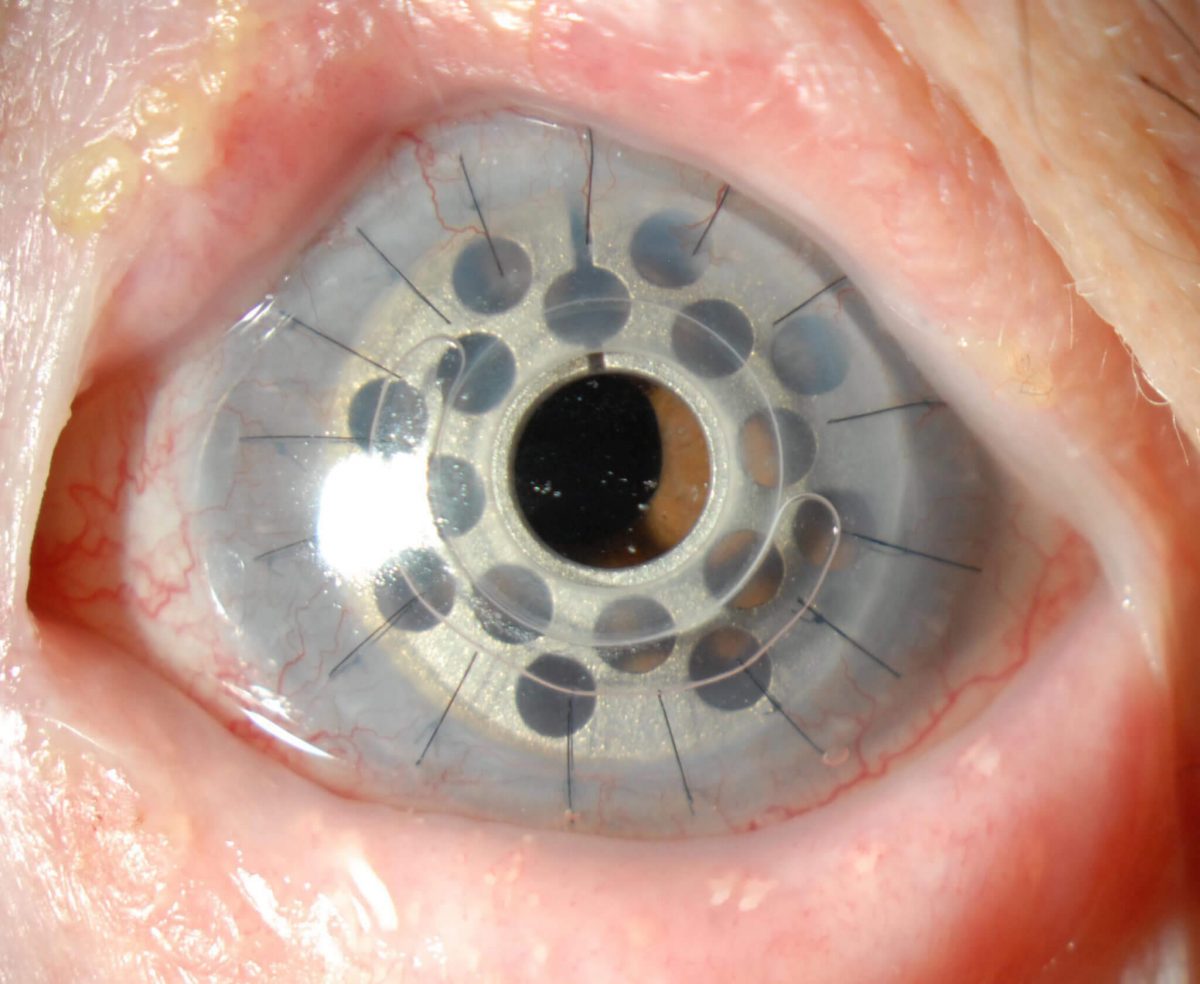 Artificial Cornea and Corneal Implant Market Analysis, Business Development, Size, Share, Trends, Industry Analysis, Forecast 2024 – 2032