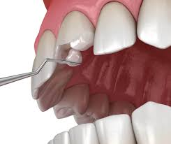 Restorative Dentistry Market By Product Application Manufacturer Sales and Segmentation – Forecast to 2024 – 2032