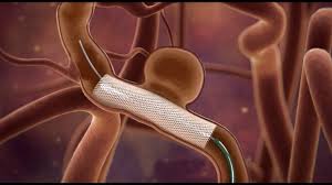 Intracranial Stents Market Growth, Size, Opportunities and Analysis Forecast 2024 – 2032