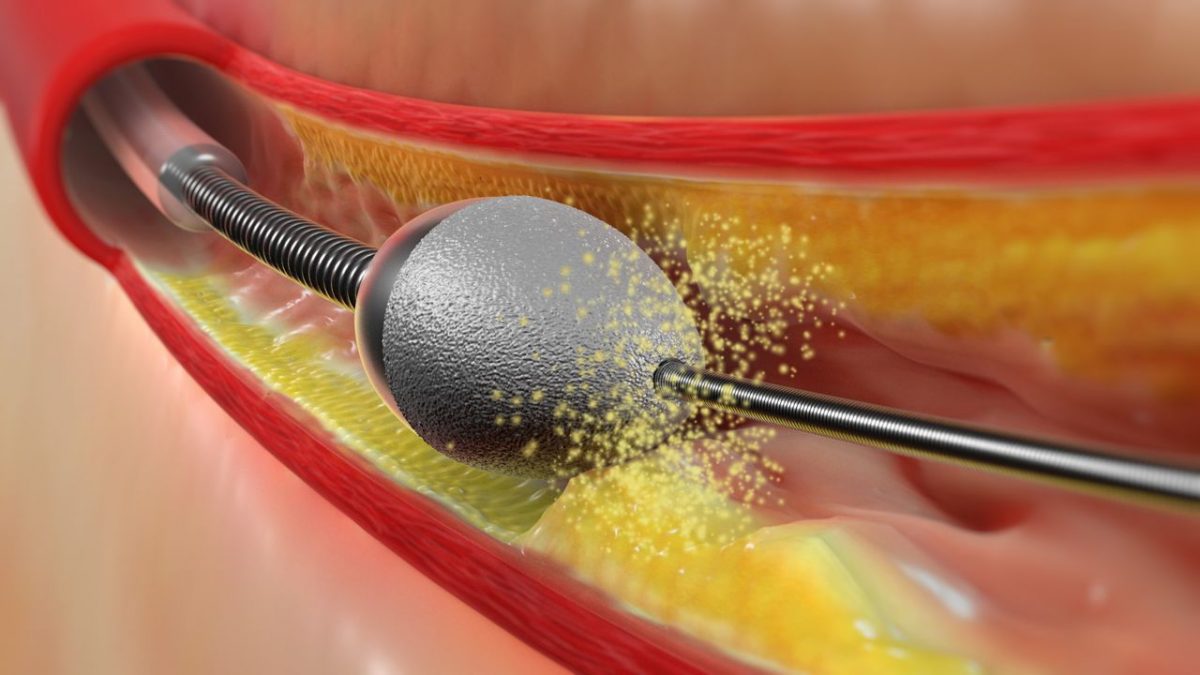 atherectomyrotational