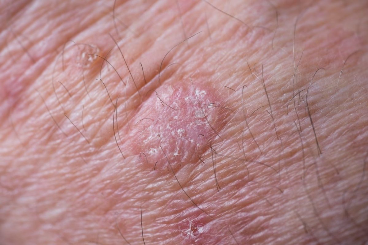 Actinic Keratosis