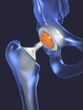 Function of a hip joint implant or hip prosthesis in frontal view - 3d illustration