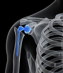Shoulder Replacement Market Growth, Share, Opportunities & Competitive Analysis, 2024 – 2032