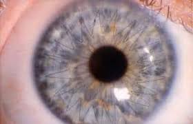 Corneal Implants