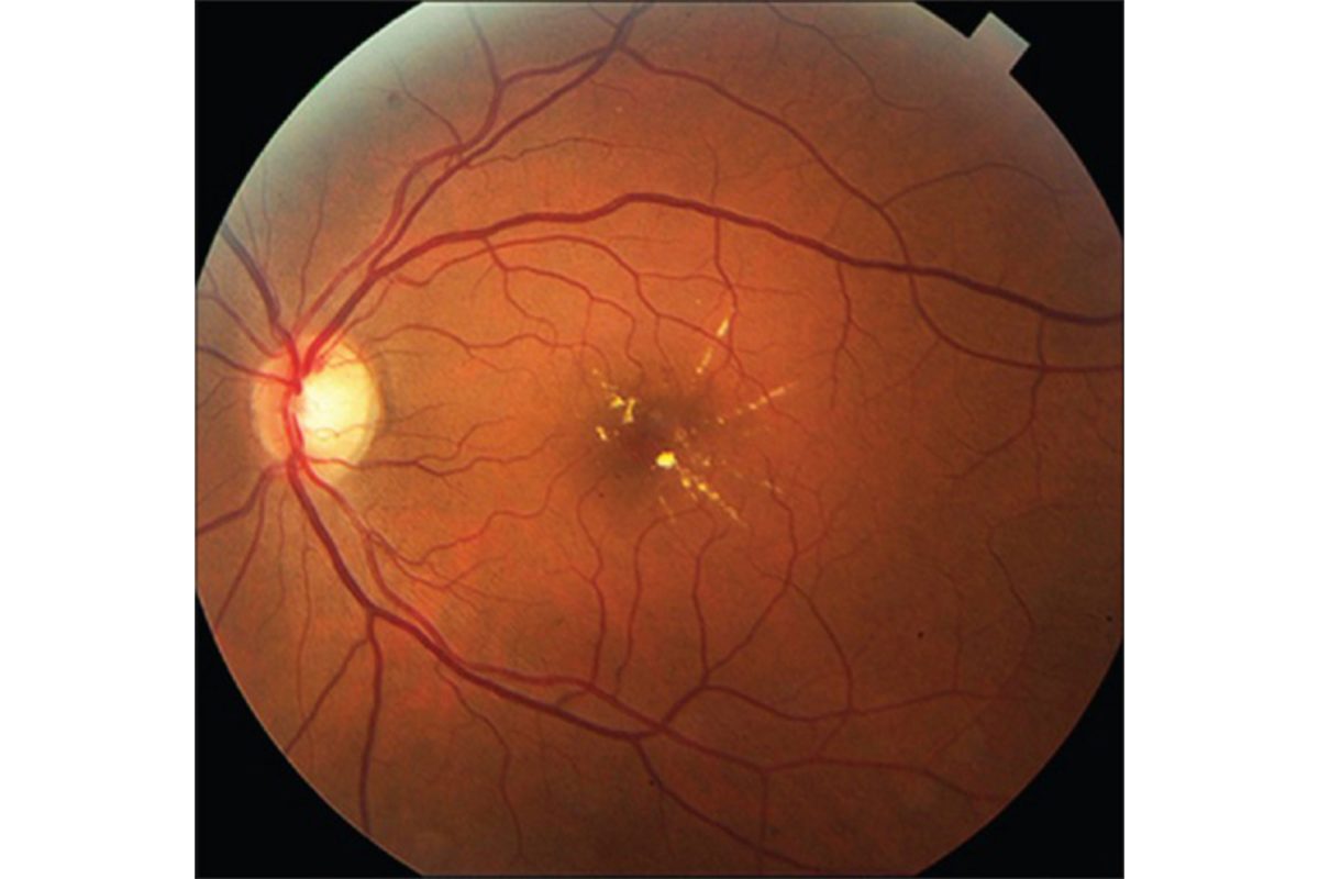 Diabetic Macular Edema Market Growth, Share, Opportunities & Competitive Analysis, 2024 – 2032