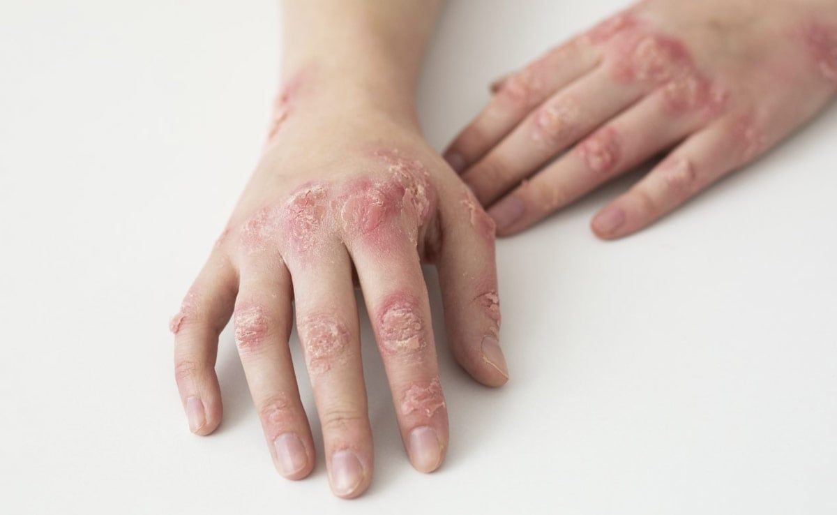 Why is Topical Medication Preferred for Antifungal Infections?