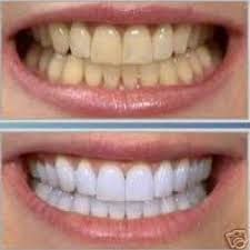 Sbiancamento denti prima e dopo