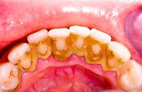 Costo pulizia denti - DentistaDentista