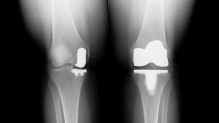 Quando l'artrosi del ginocchio non può essere fermata, un'endoprotesi può aiutare