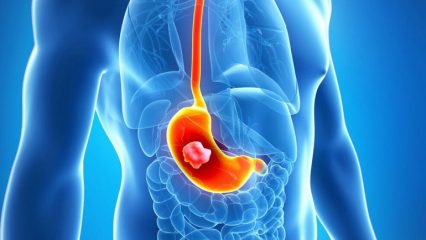 Quali alimenti provocano il cancro allo stomaco, al tratto gastrointestinale, un elenco di alimenti dannosi che possono influenzare lo sviluppo del tumore.