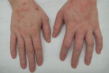 Trattamento efficace della dermatite seborroica, mezzi e metodi