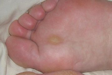 Segni di un piede diabetico nel diabete mellito, come determinare, prevenzione