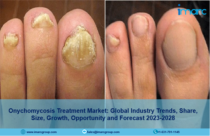 Onychomycosis Treatment Market Report 2023, Industry Trends, Growth, Size and Forecast Till 2028