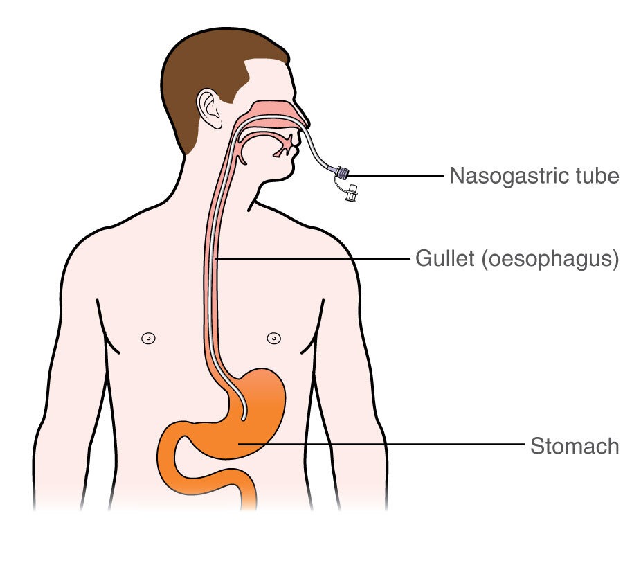 Nasogastric Tube Market Size, Growth, Trends and Forecast 2024-2032