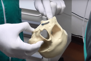 implantologia senza osso brescia