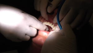 Implantologia brescia