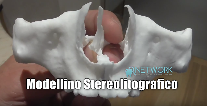 modellino-stereolitografico-implantologia