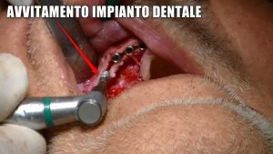 implantologia split crest