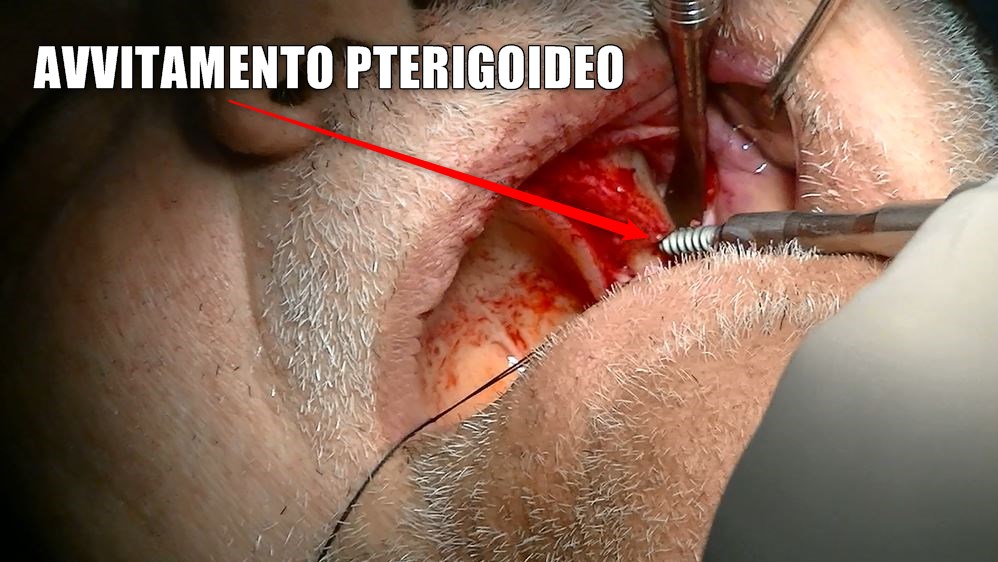 impianto dentale pterigoideo