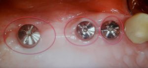 impianto dentale senza osso impianto pterigoideo