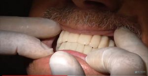 Implantologia dentale senza osso