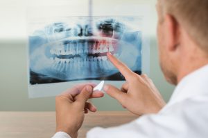 Implantologia dentale verona Prezzi