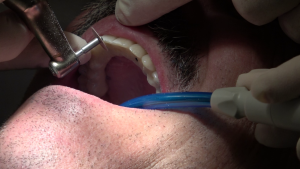 implantologia dentale a carico immediato