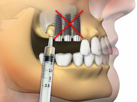 rigenerazione ossea dentale è dolorosa Archivi - IMPLANTOLOGIA DENTALE  PREZZI | Impianti senza osso