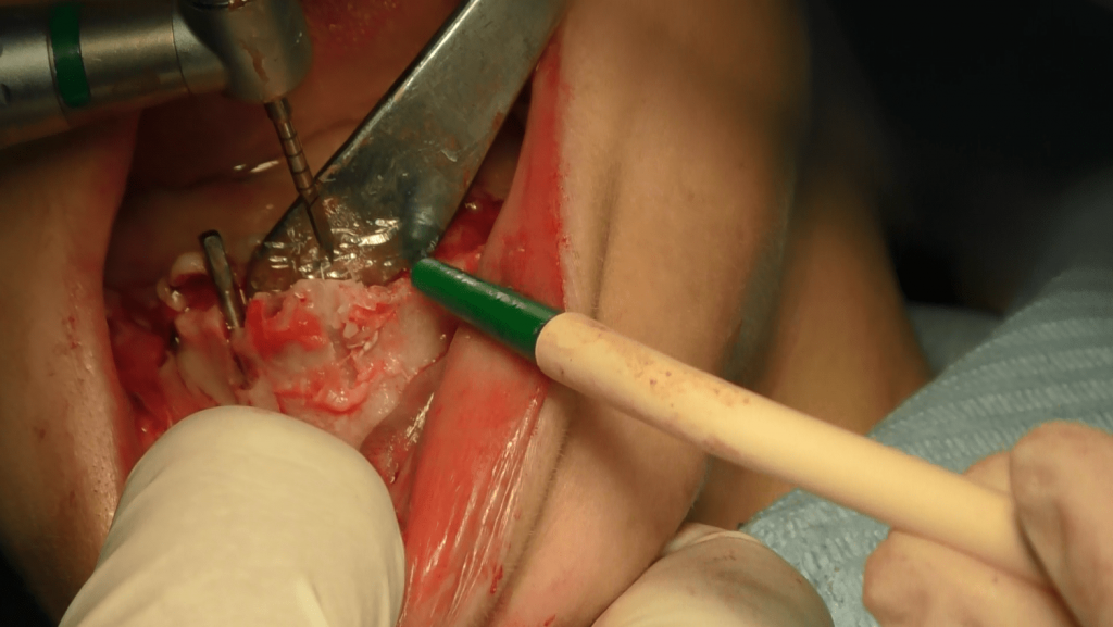 implantologia poco osso