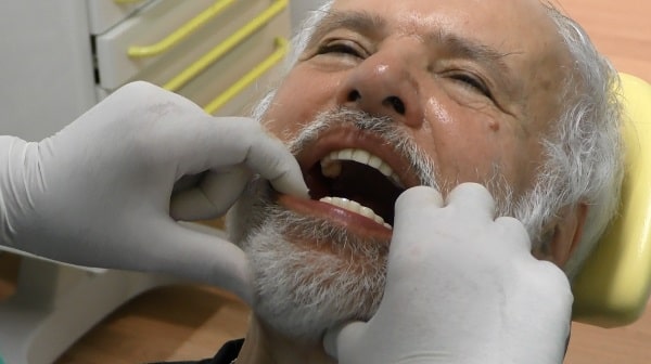 impianti dentali a acarico immediato032-min