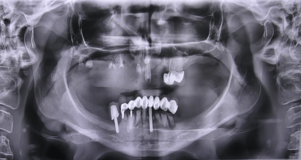 rigenerazione ossea dentale rischio Archivi - IMPLANTOLOGIA DENTALE PREZZI  | Impianti senza osso