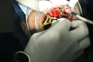 Implantologia sottoperiostei