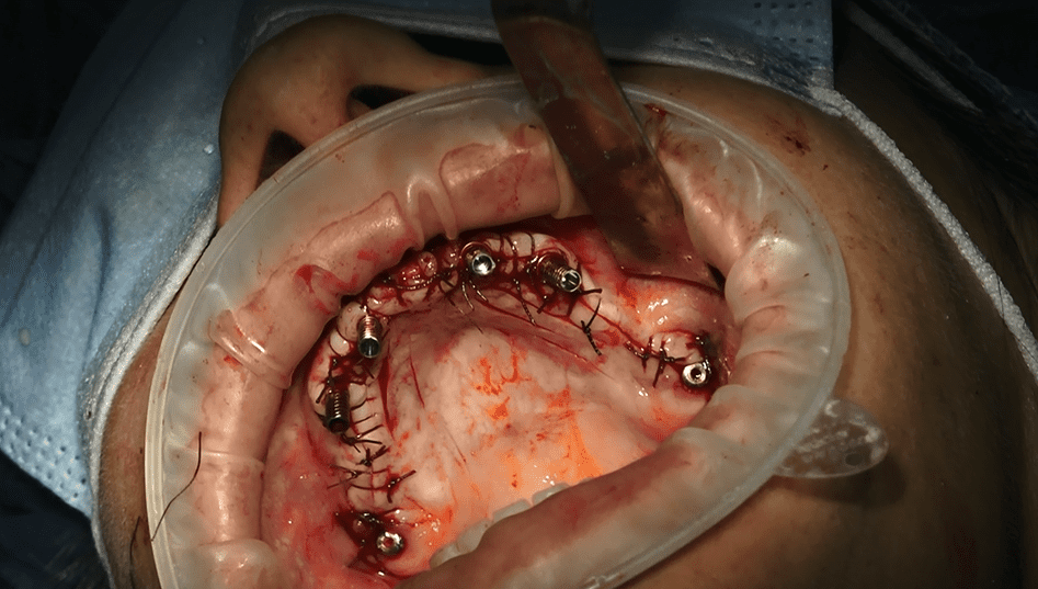 Implantologia sottoperiostei