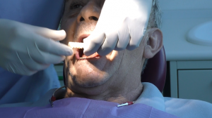 circolari dentali fissi senza gengiva