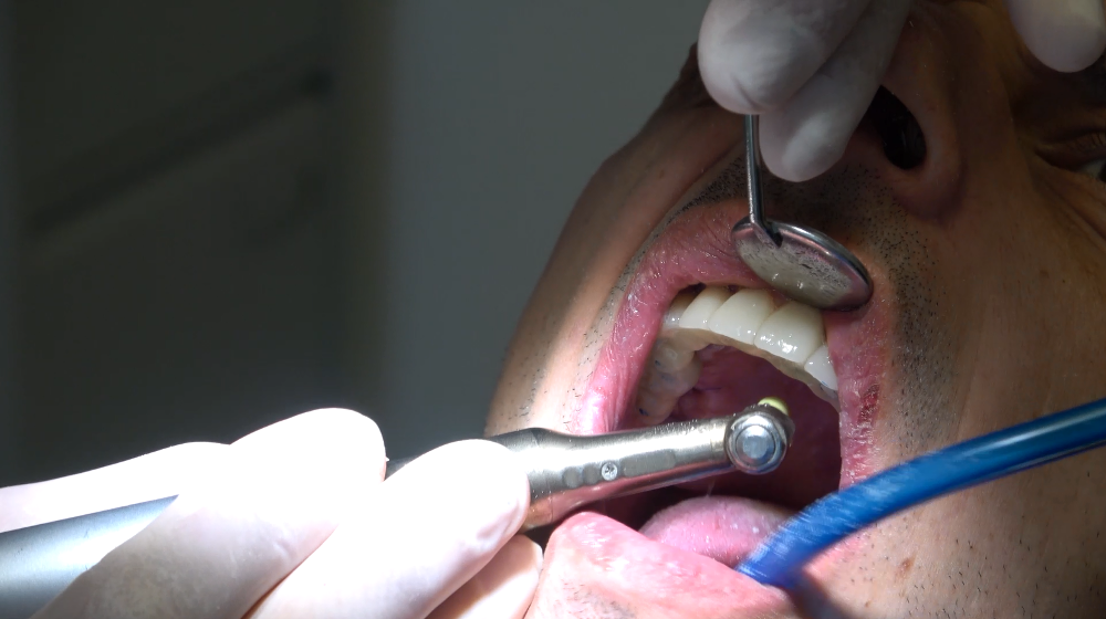 circolari dentali fissi senza gengiva