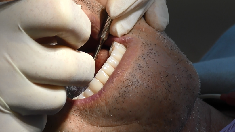 Implantologia dentale senza finta gengiva