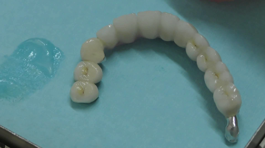 Implantologia dentale senza finta gengiva