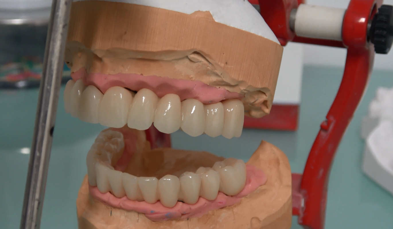 protesi dentali a bottone immagini