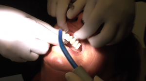 implantologia dentale impianti denti