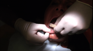 implantologia impianti denti