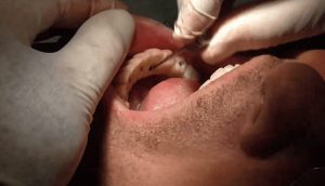 implantologia dnetale impianti denti