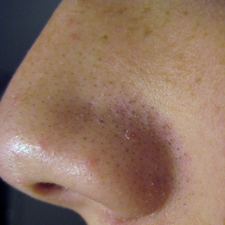 L’acne: come si manifesta?