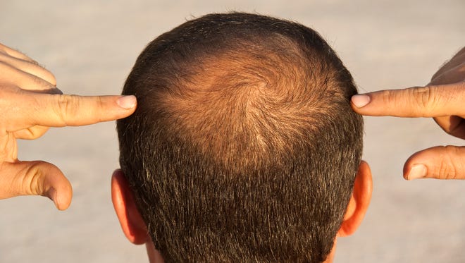 Alopecia Treatment Market Size 2023 | Industry Trends, Share and Forecast 2028