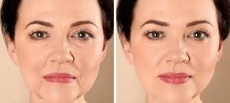 Non-Surgical Skin Tightening Market Growth, Share, Size & Forecast 2024-2032