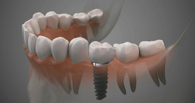 What Makes Dental Implants Better Than Other Tooth Replacement Options 1