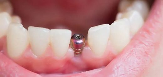 What Makes Dental Implants Better Than Other Tooth Replacement Options